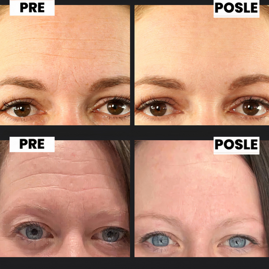 Super Trakice Protiv Bora